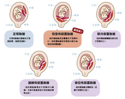 胎盤靠近子宮頸|前置胎盤有4種，一張圖帶你秒懂